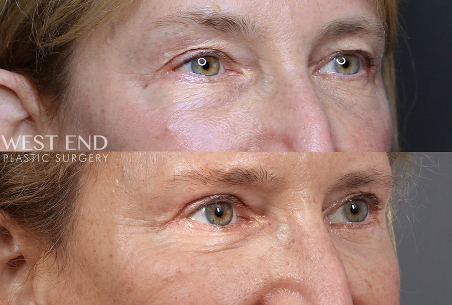 Blepharoplasty before photo. Individual results may vary.