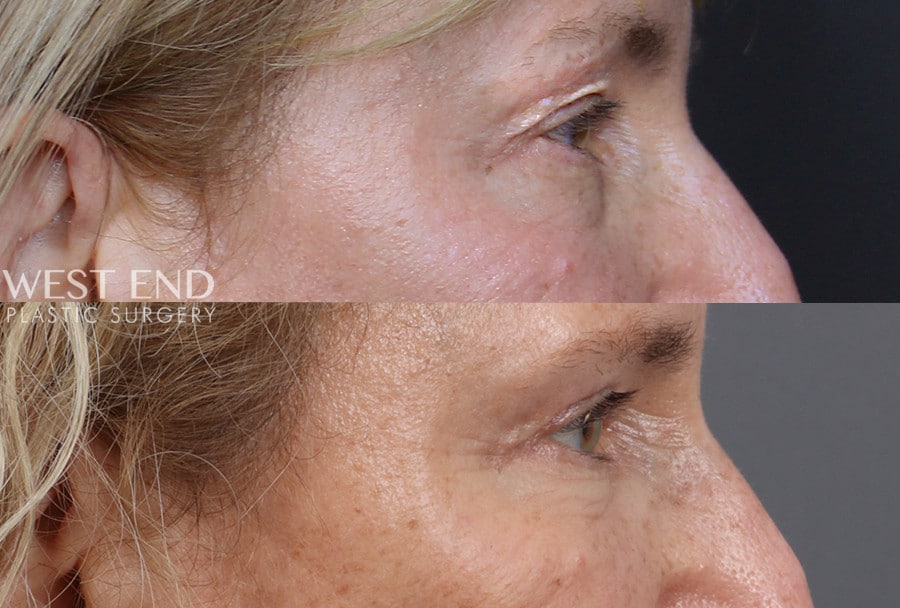 Blepharoplasty before photo. Individual results may vary.