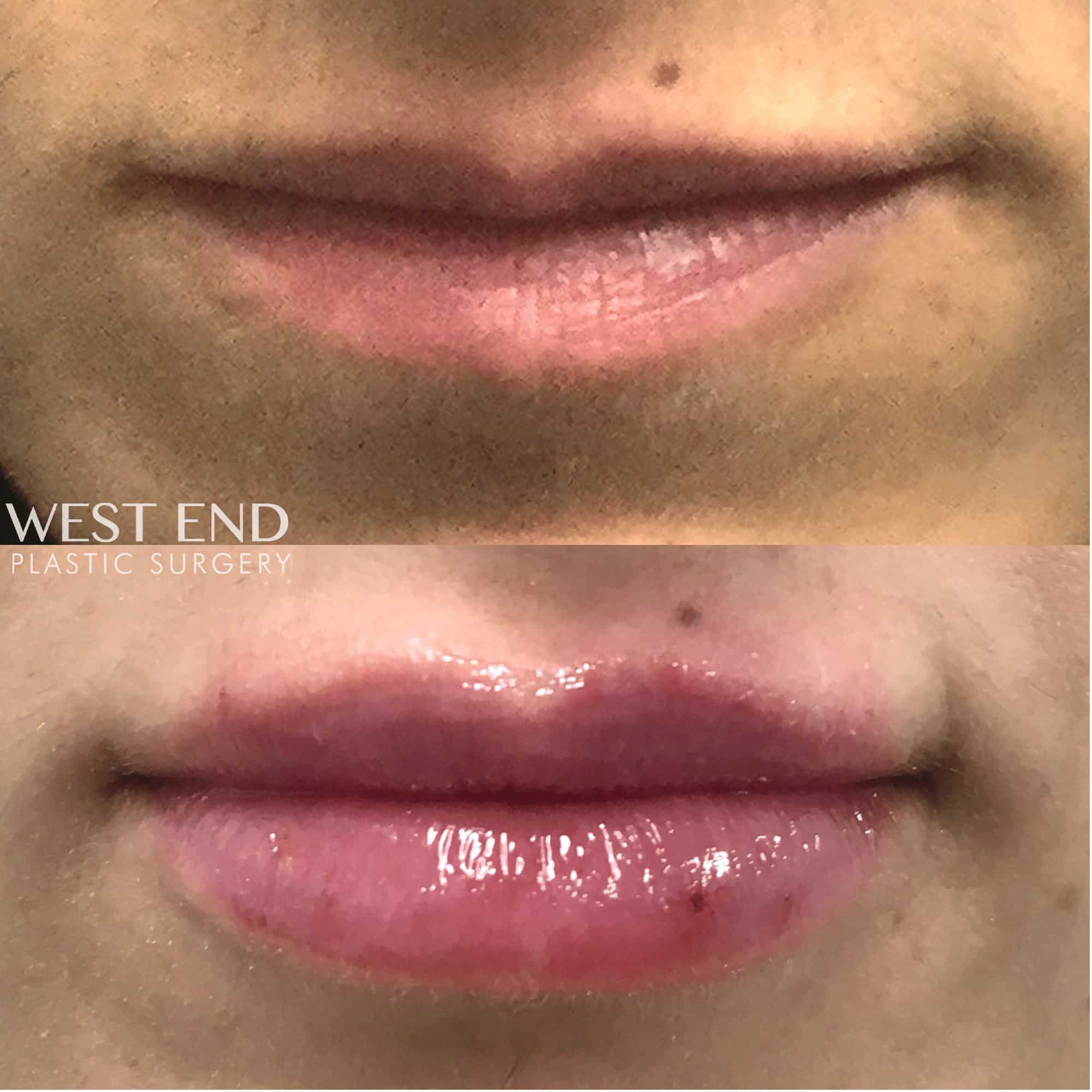 Lip Filler