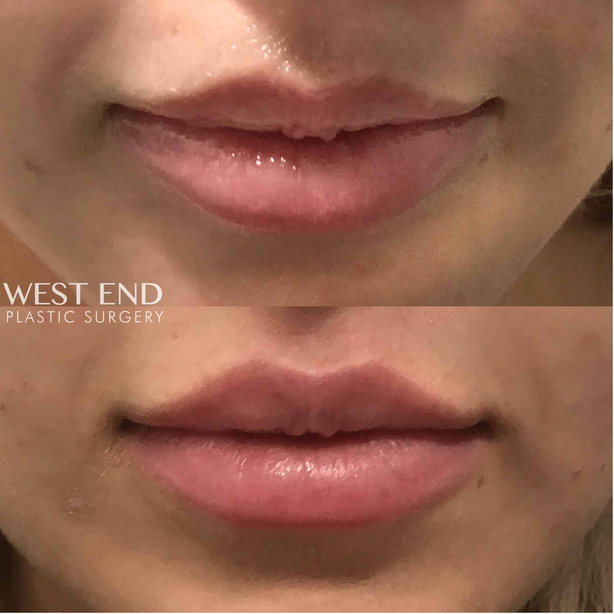 Lip Filler