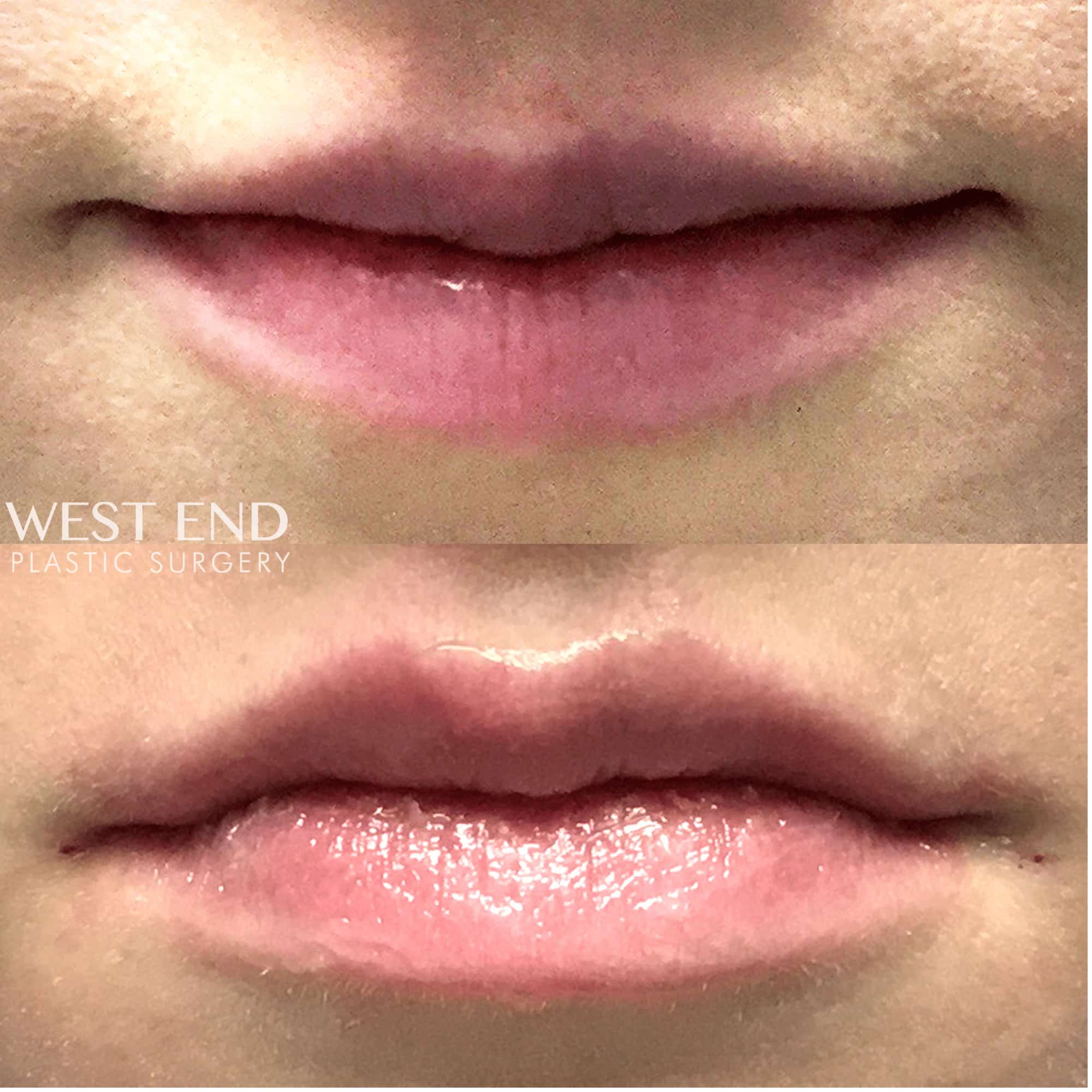 Lip Filler