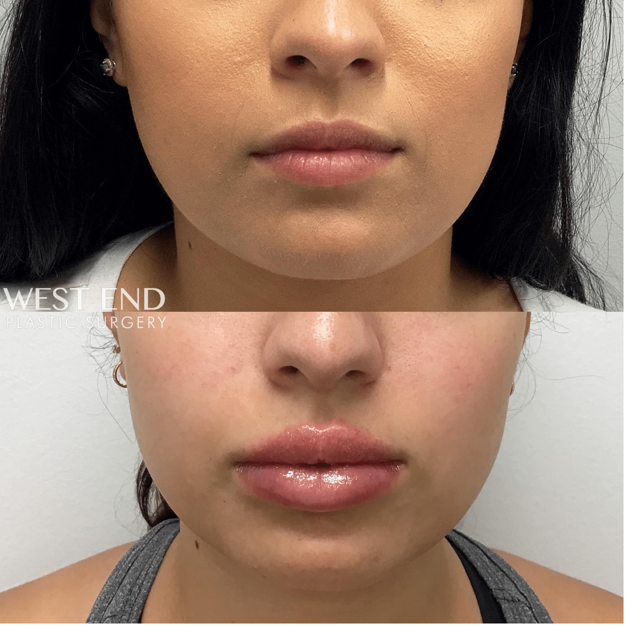 Lip Filler