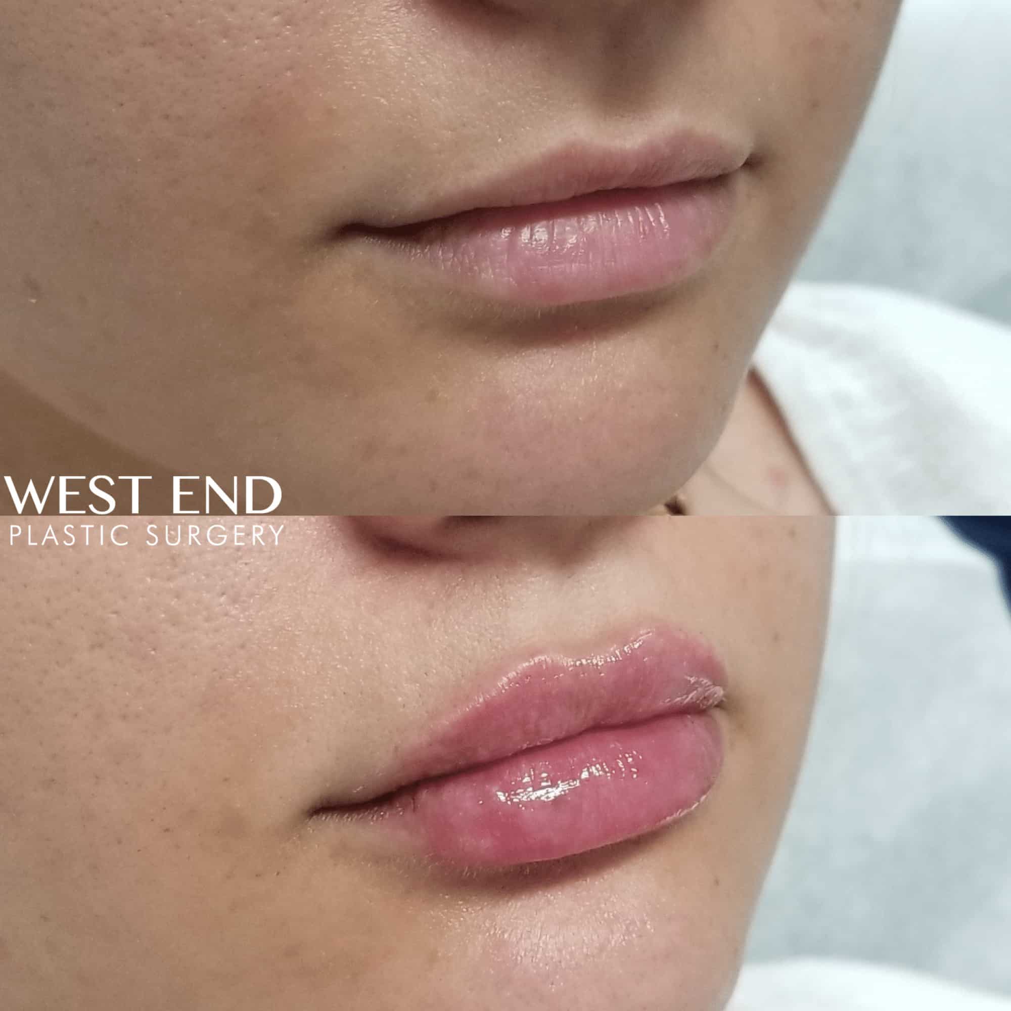 Lip Filler