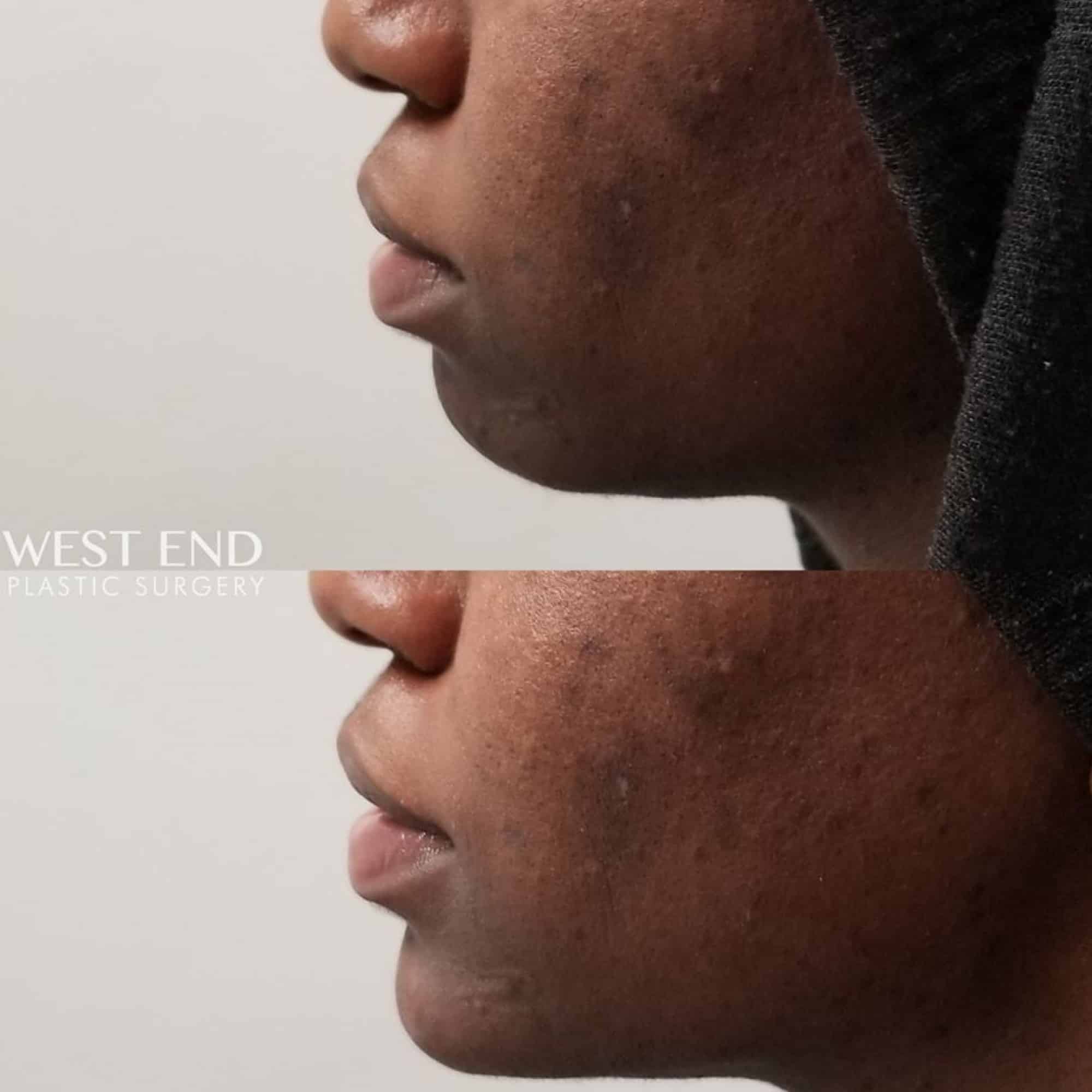 Chin Augmentation with Dermal Filler before photo. Individual results may vary.