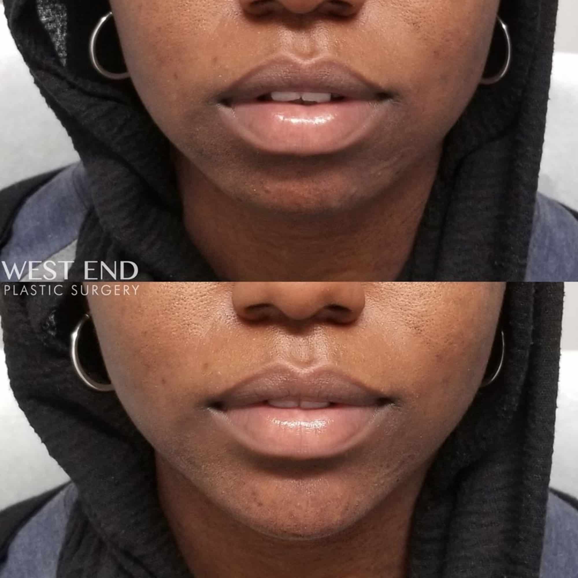 Chin Augmentation with Dermal Filler before photo. Individual results may vary.
