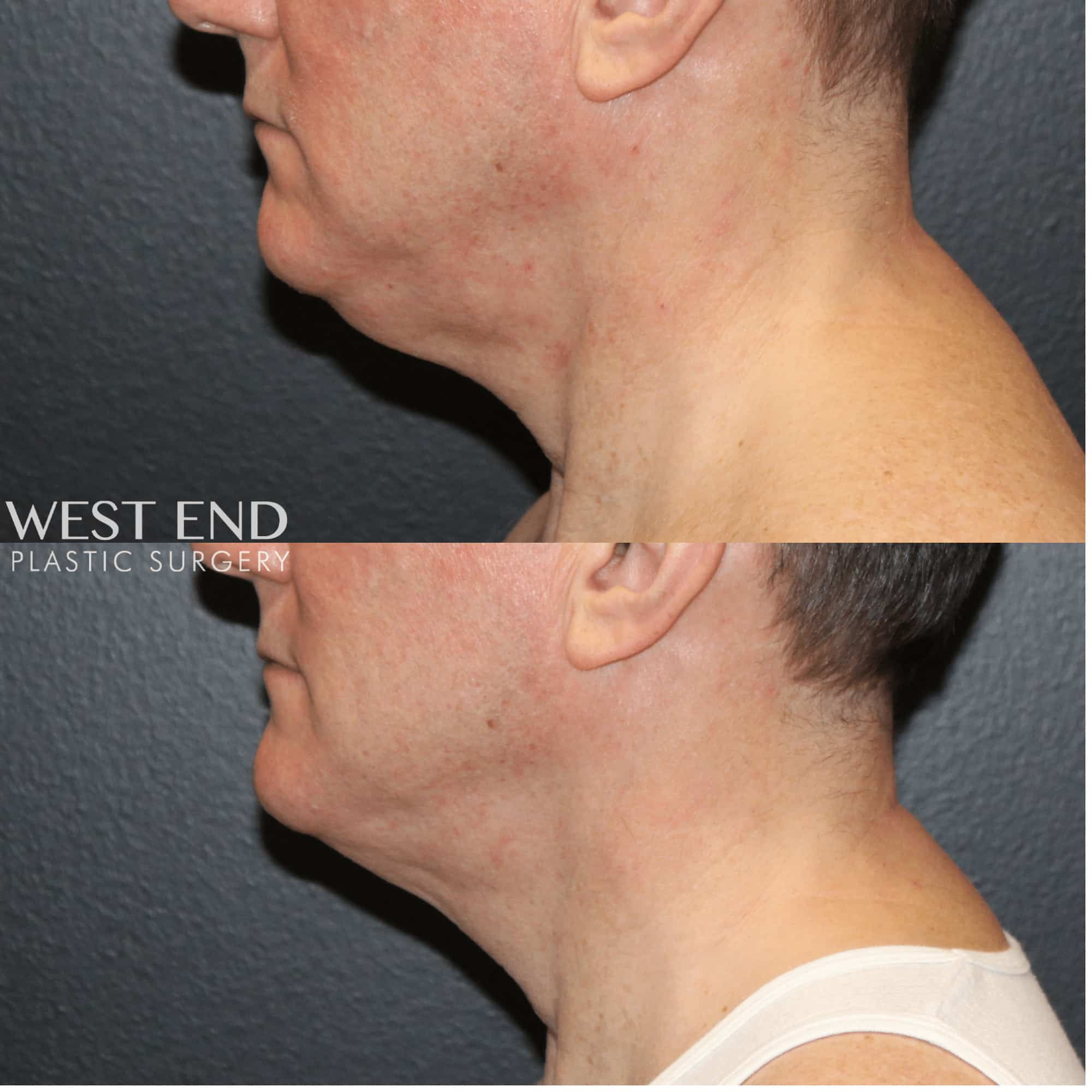 ThermiTight – Neck