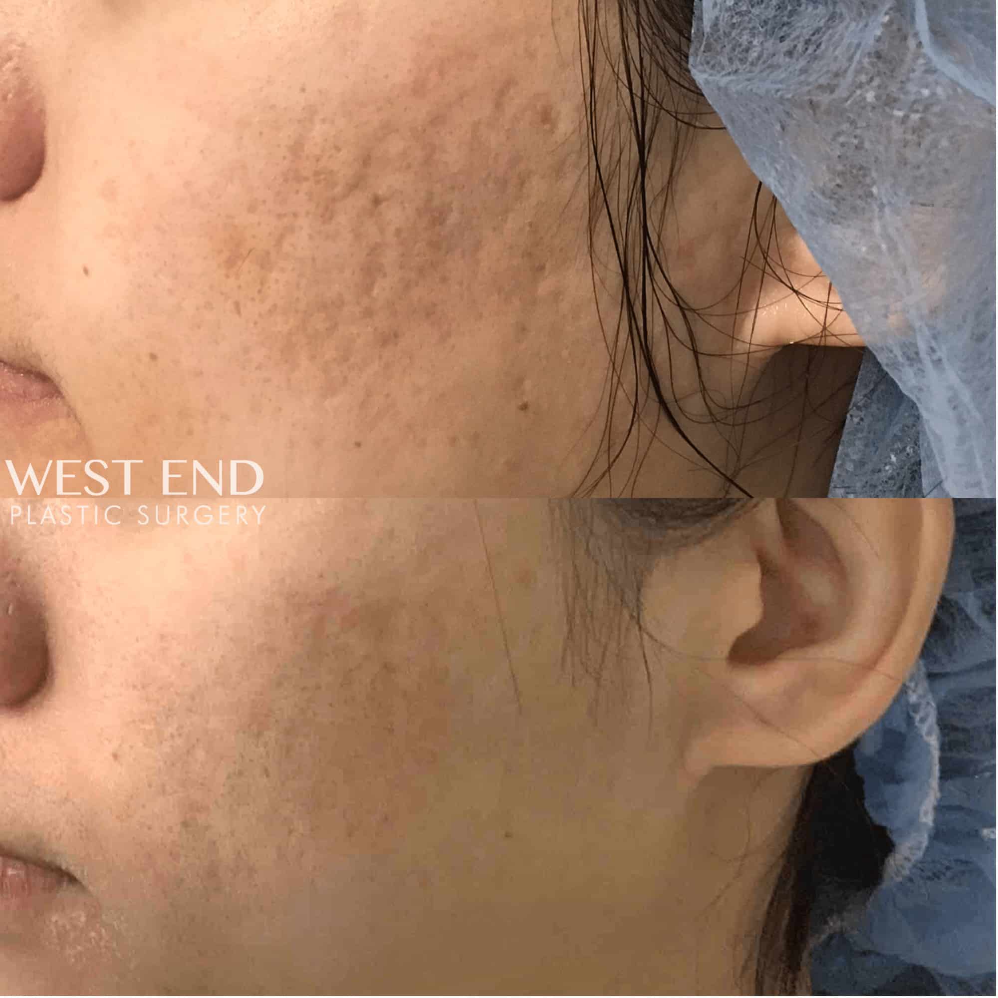Microneedling with PRP