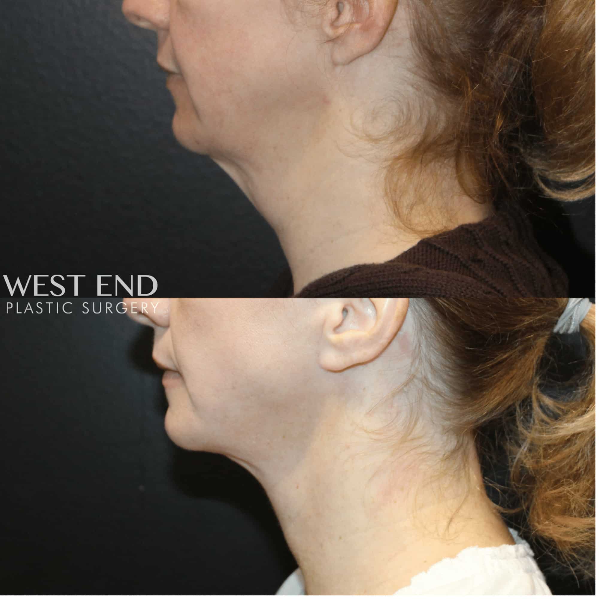 Neck Lift
