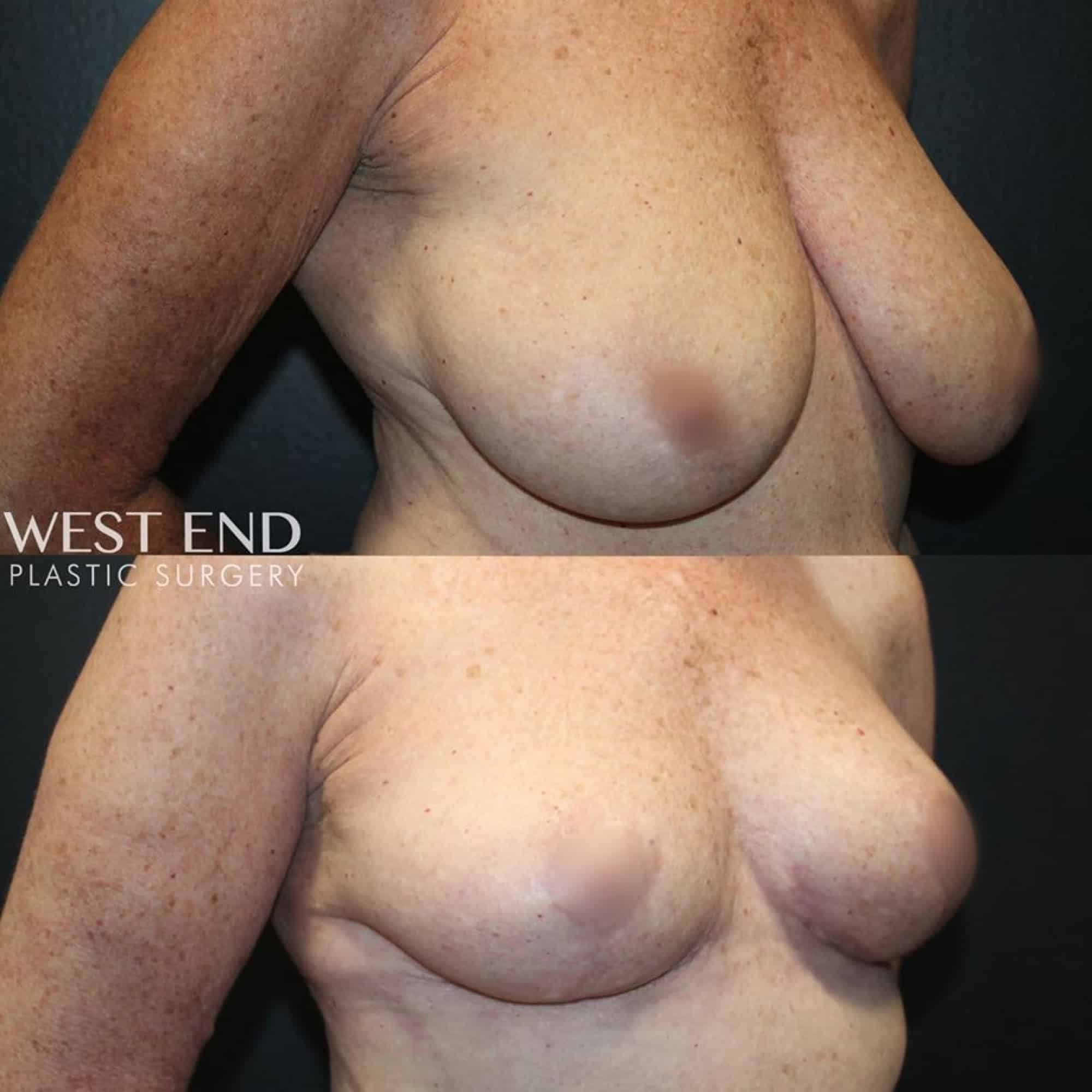 Breast Reduction