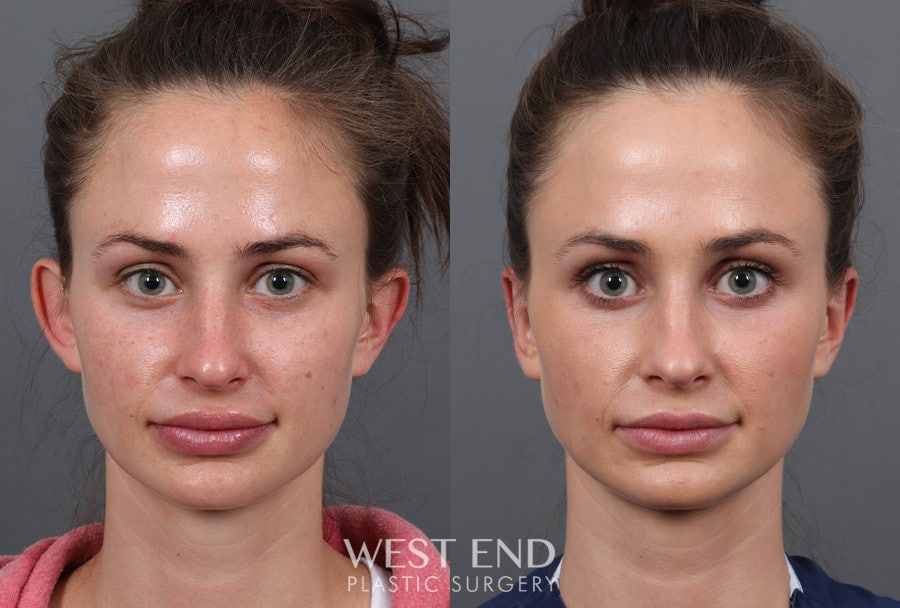 Otoplasty before photo. Individual results may vary.