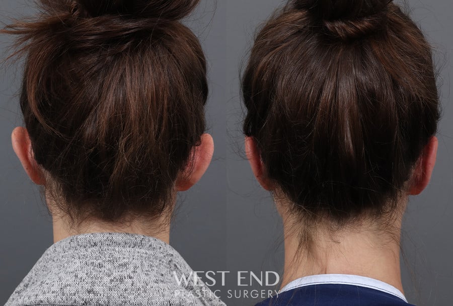 Otoplasty before photo. Individual results may vary.