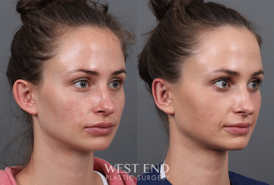 Otoplasty before photo. Individual results may vary.