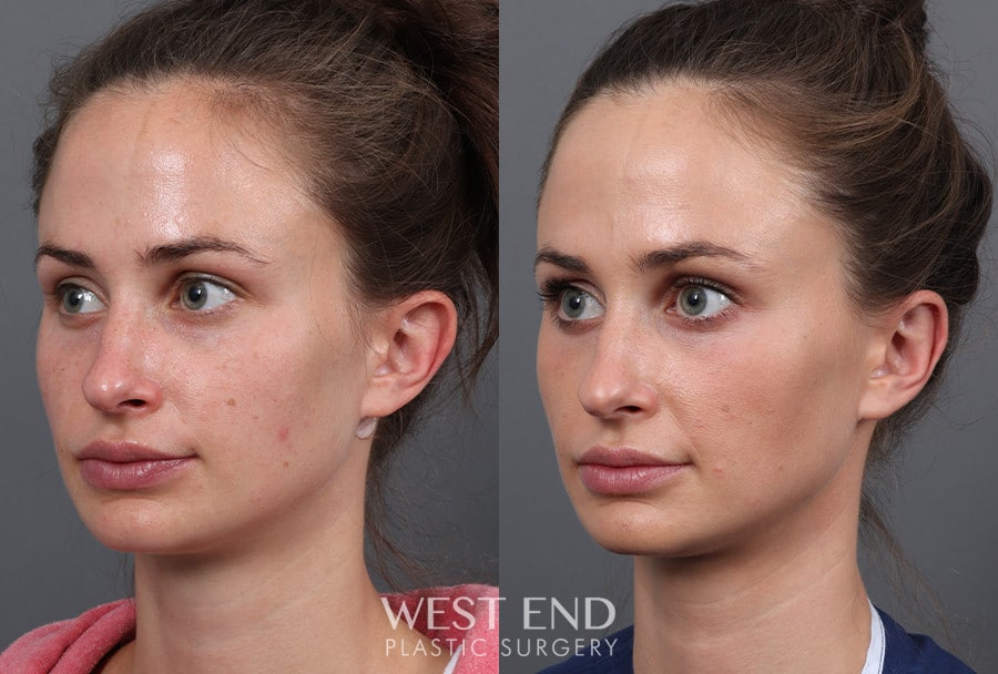 Otoplasty before photo. Individual results may vary.