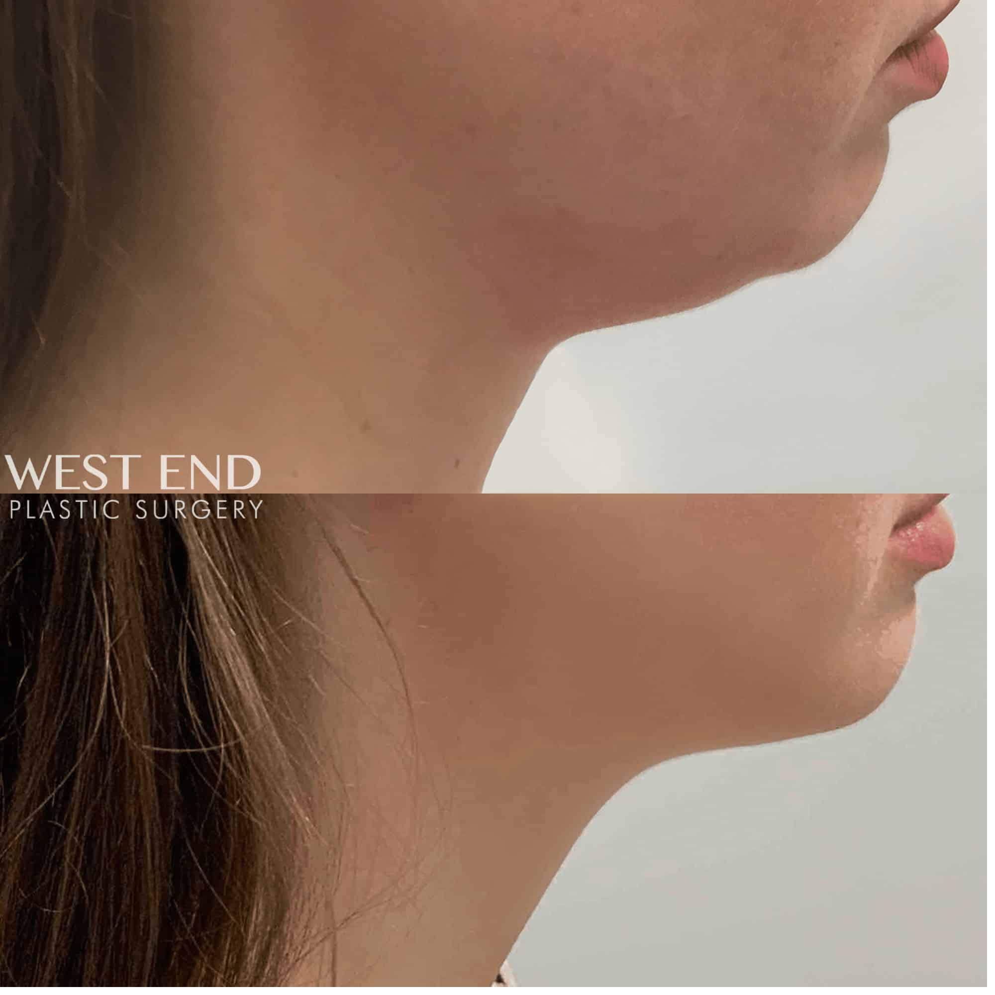 Kybella