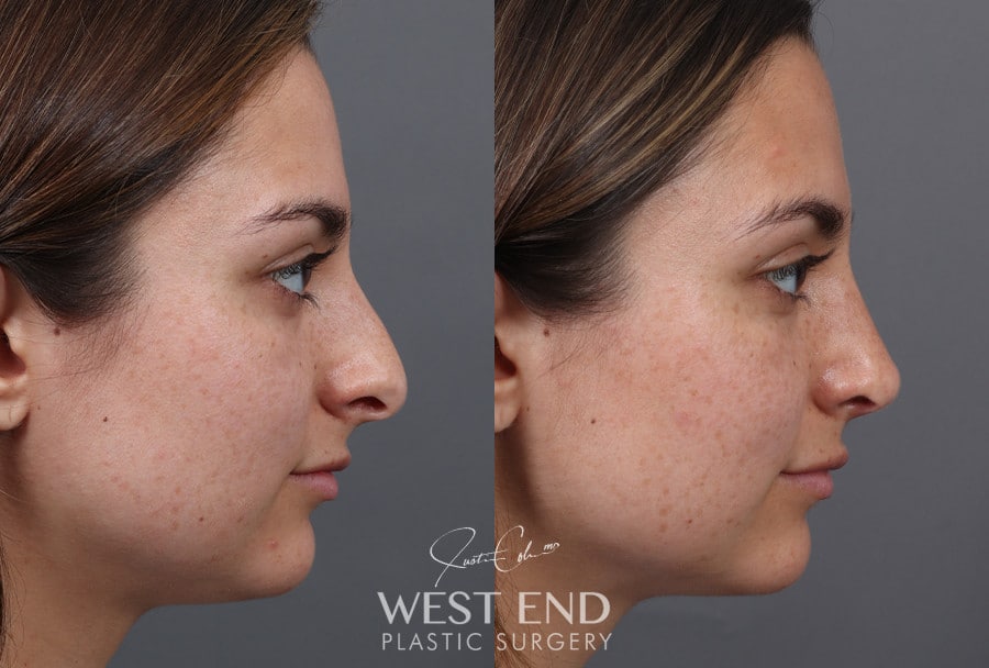 Rhinoplasty before photo. Individual results may vary.