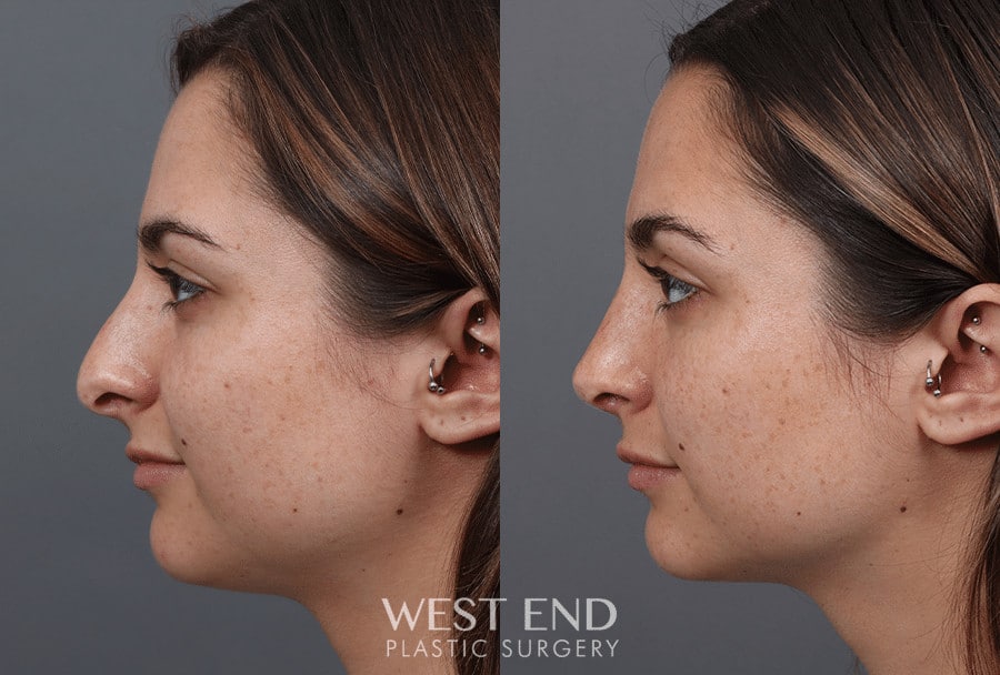 Rhinoplasty before photo. Individual results may vary.