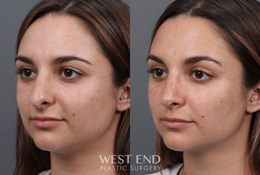Rhinoplasty before photo. Individual results may vary.