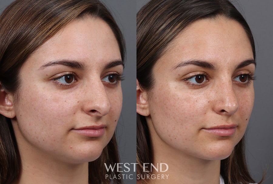 Rhinoplasty before photo. Individual results may vary.