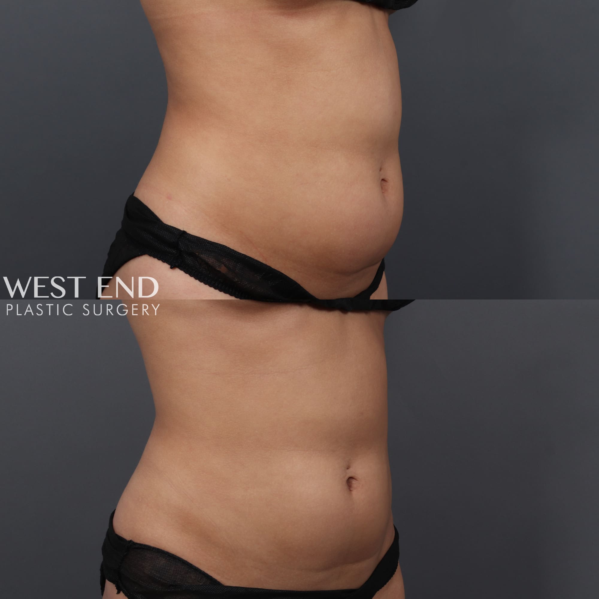CoolSculpting