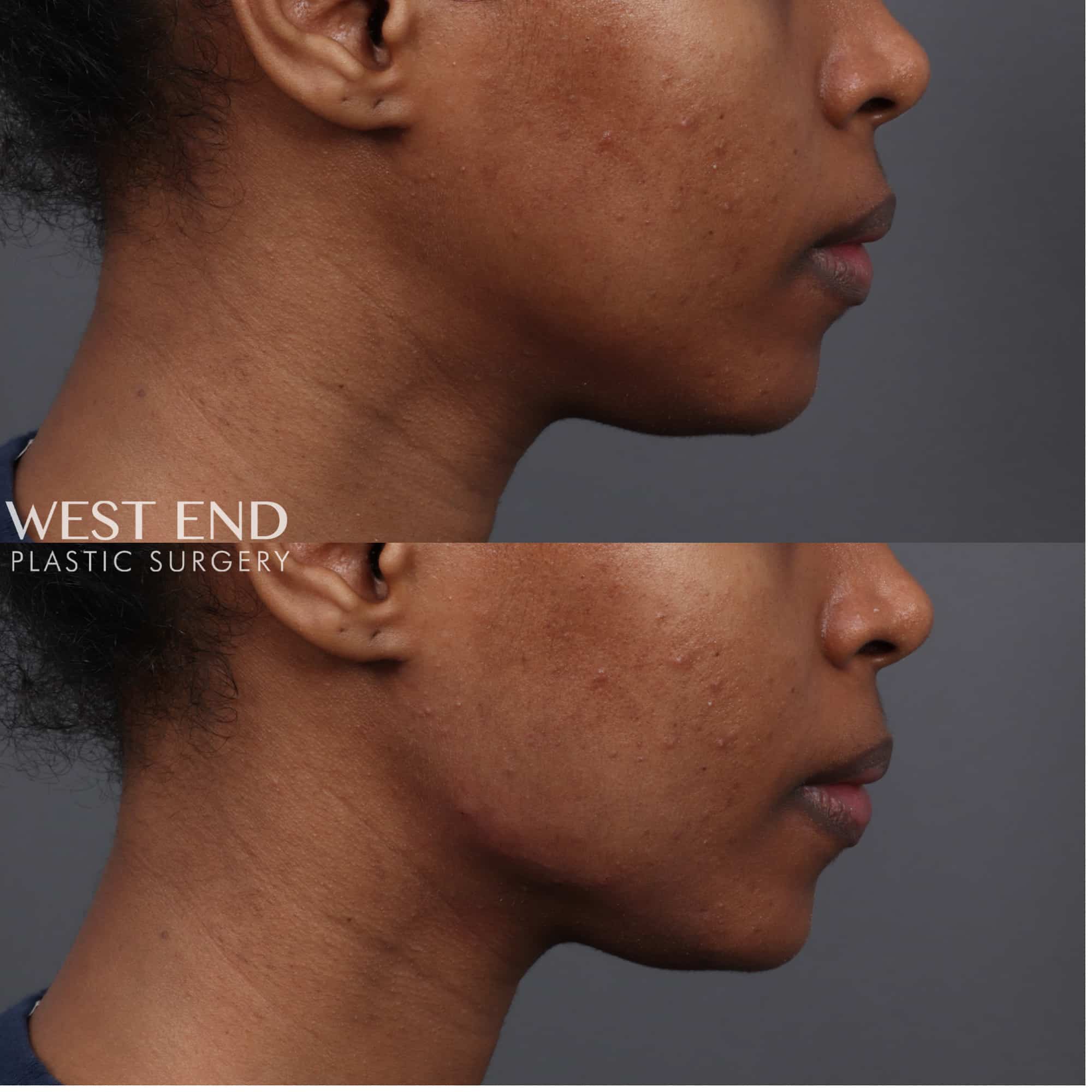 Jawline Filler before photo. Individual results may vary.