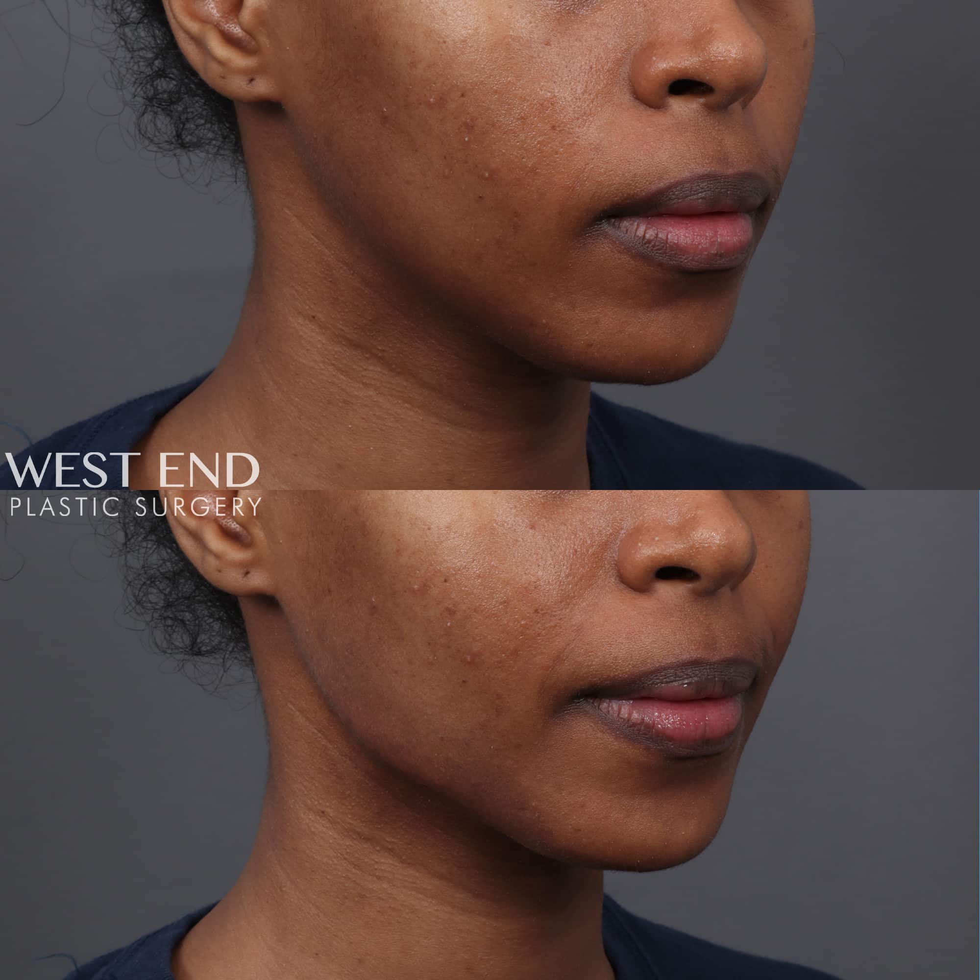 Jawline Filler before photo. Individual results may vary.
