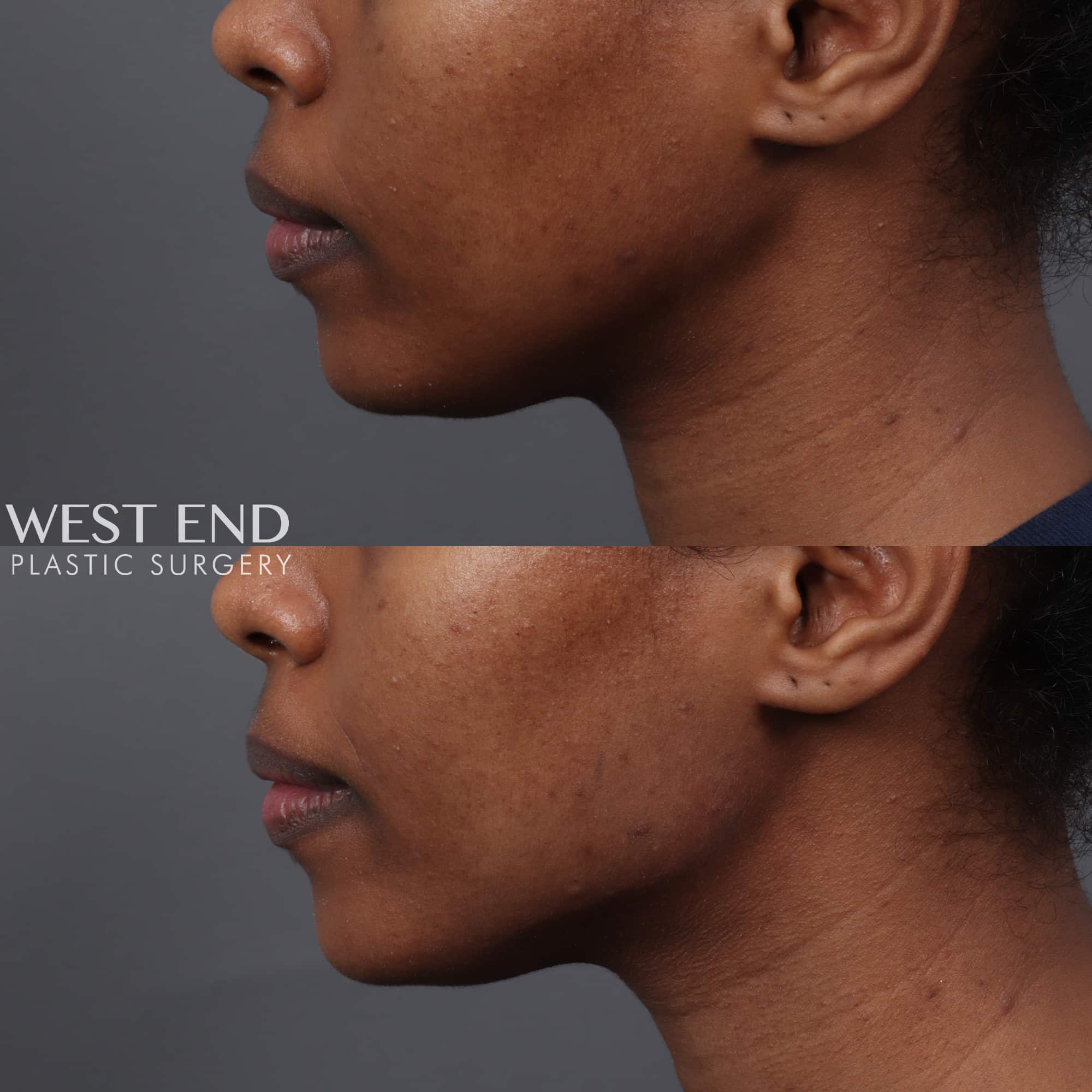 Jawline Filler before photo. Individual results may vary.