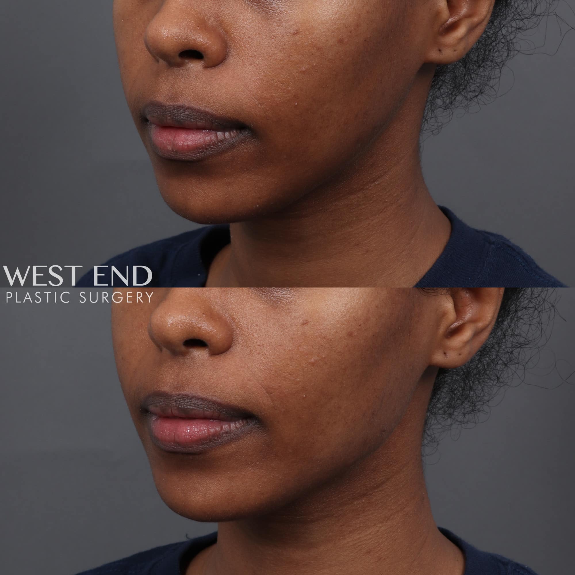 Jawline Filler before photo. Individual results may vary.