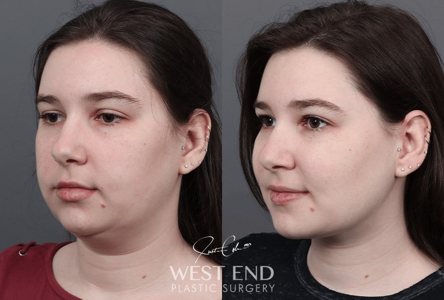 Neck Liposuction and Buccal Fat Pad Removal before photo. Individual results may vary.