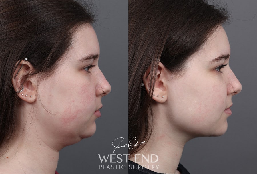 Neck Liposuction and Buccal Fat Pad Removal before photo. Individual results may vary.