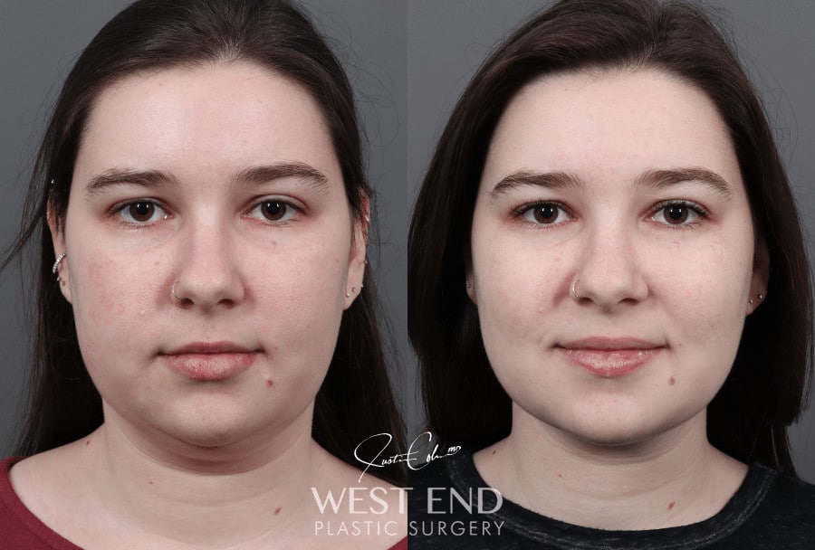 Neck Liposuction and Buccal Fat Pad Removal before photo. Individual results may vary.