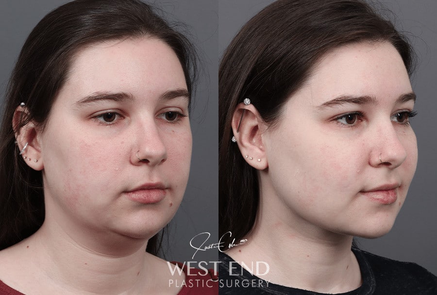 Neck Liposuction and Buccal Fat Pad Removal before photo. Individual results may vary.