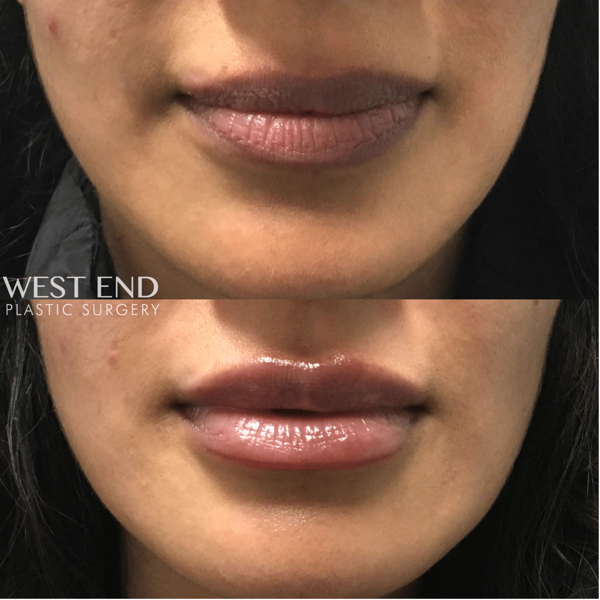 Lip Filler