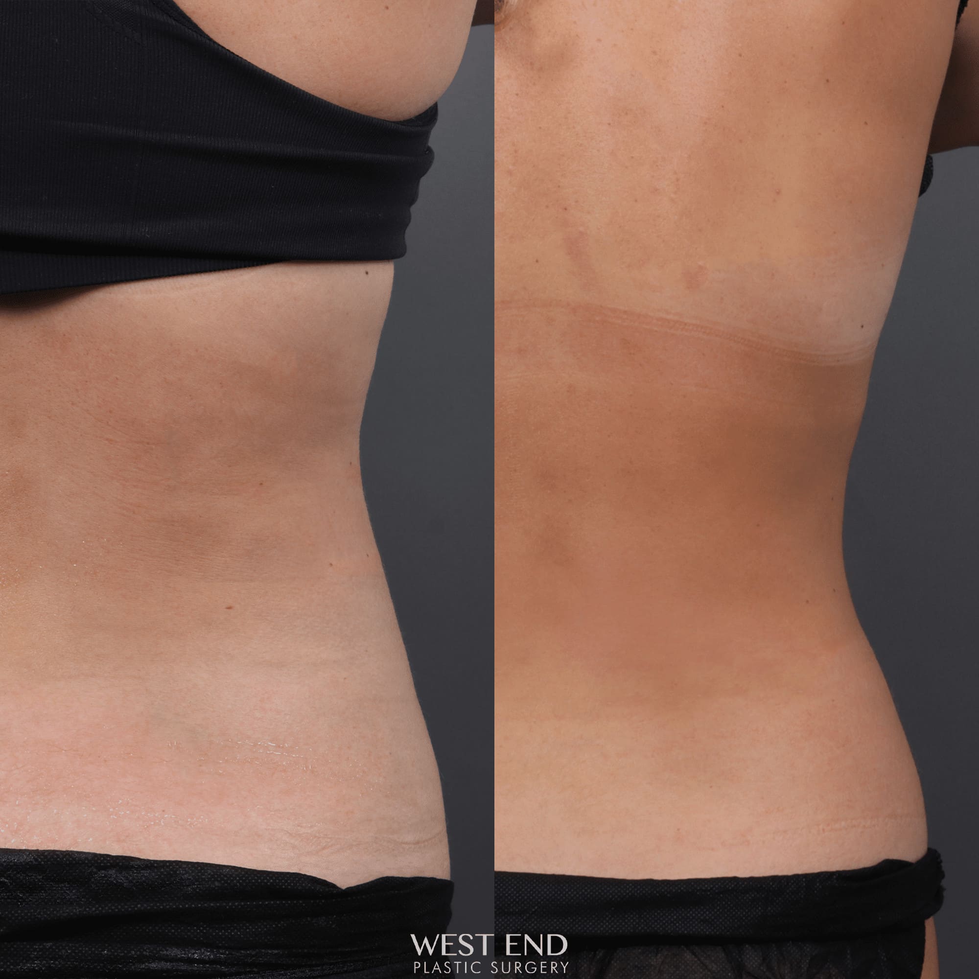 CoolSculpting