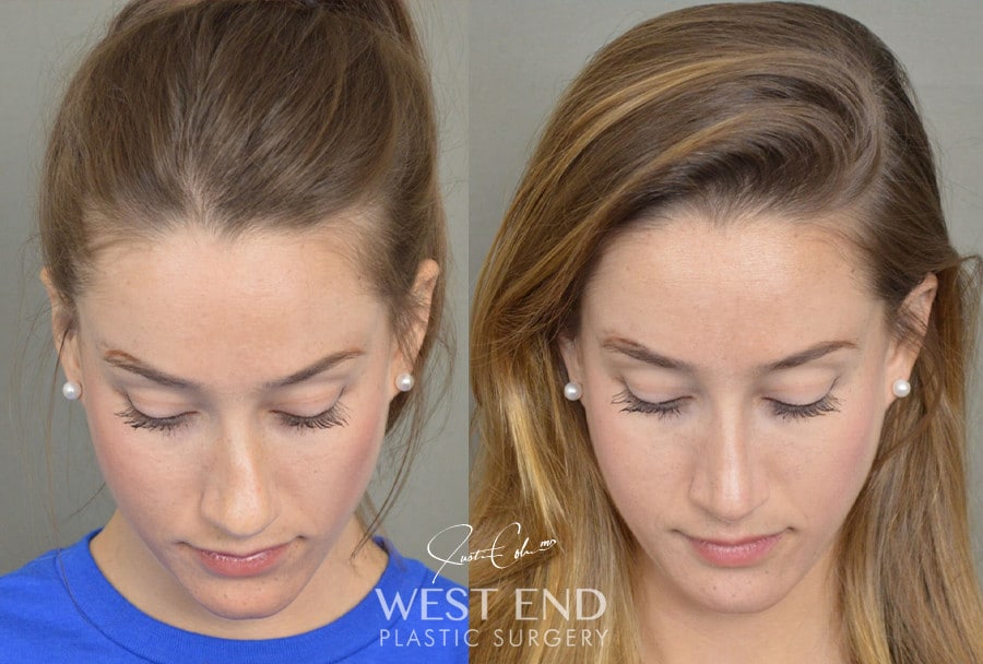 Rhinoplasty before photo. Individual results may vary.