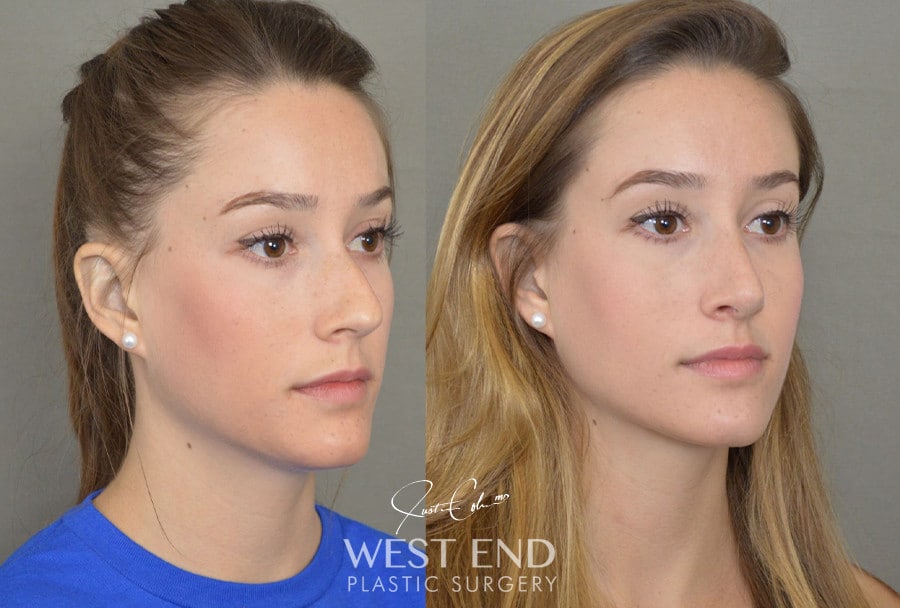 Rhinoplasty before photo. Individual results may vary.
