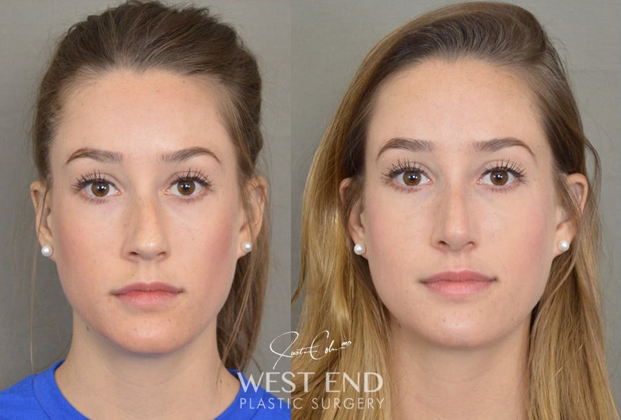 Rhinoplasty before photo. Individual results may vary.
