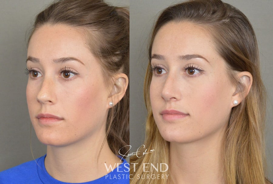 Rhinoplasty before photo. Individual results may vary.