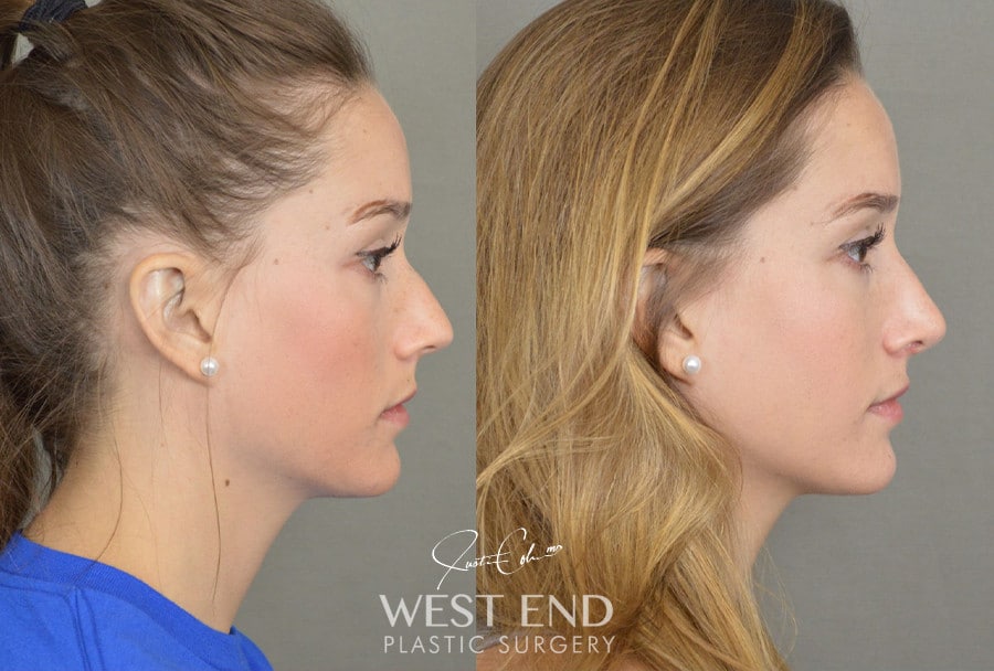 Rhinoplasty before photo. Individual results may vary.