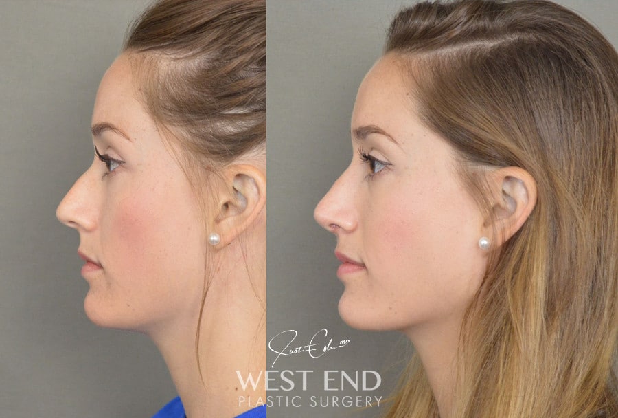 Rhinoplasty before photo. Individual results may vary.