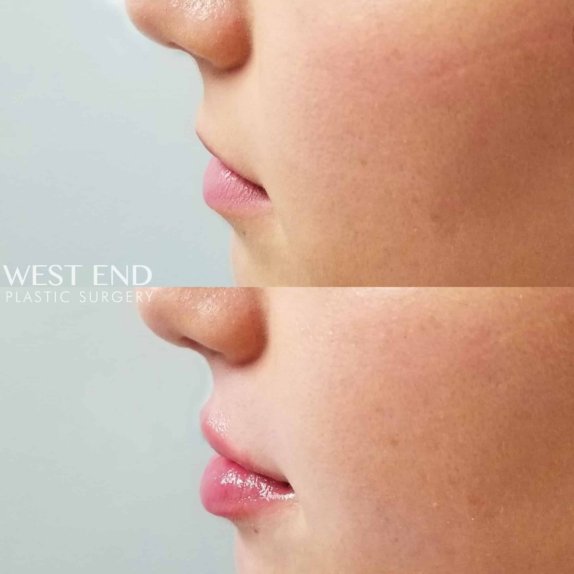 Lip Filler