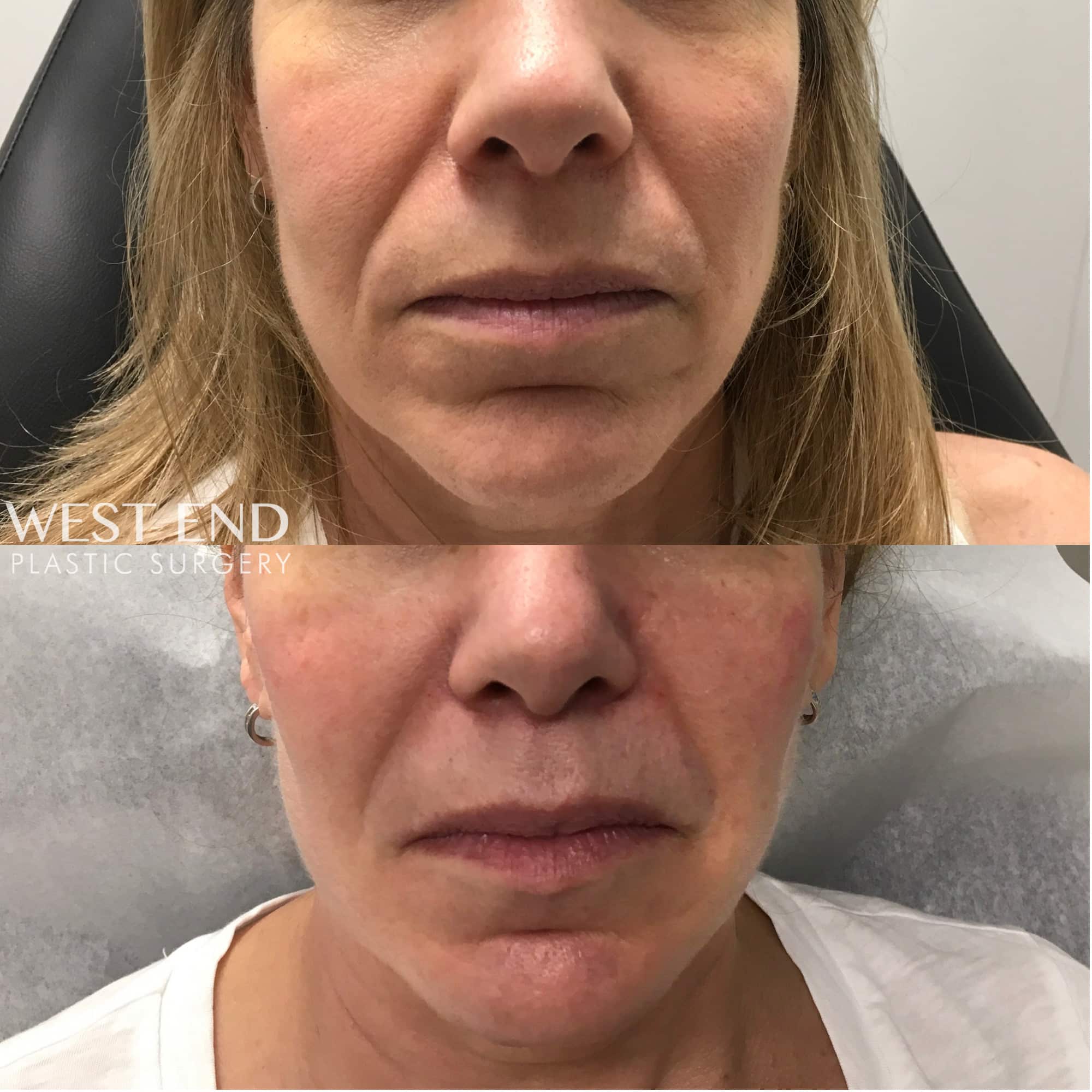 Cheek Filler