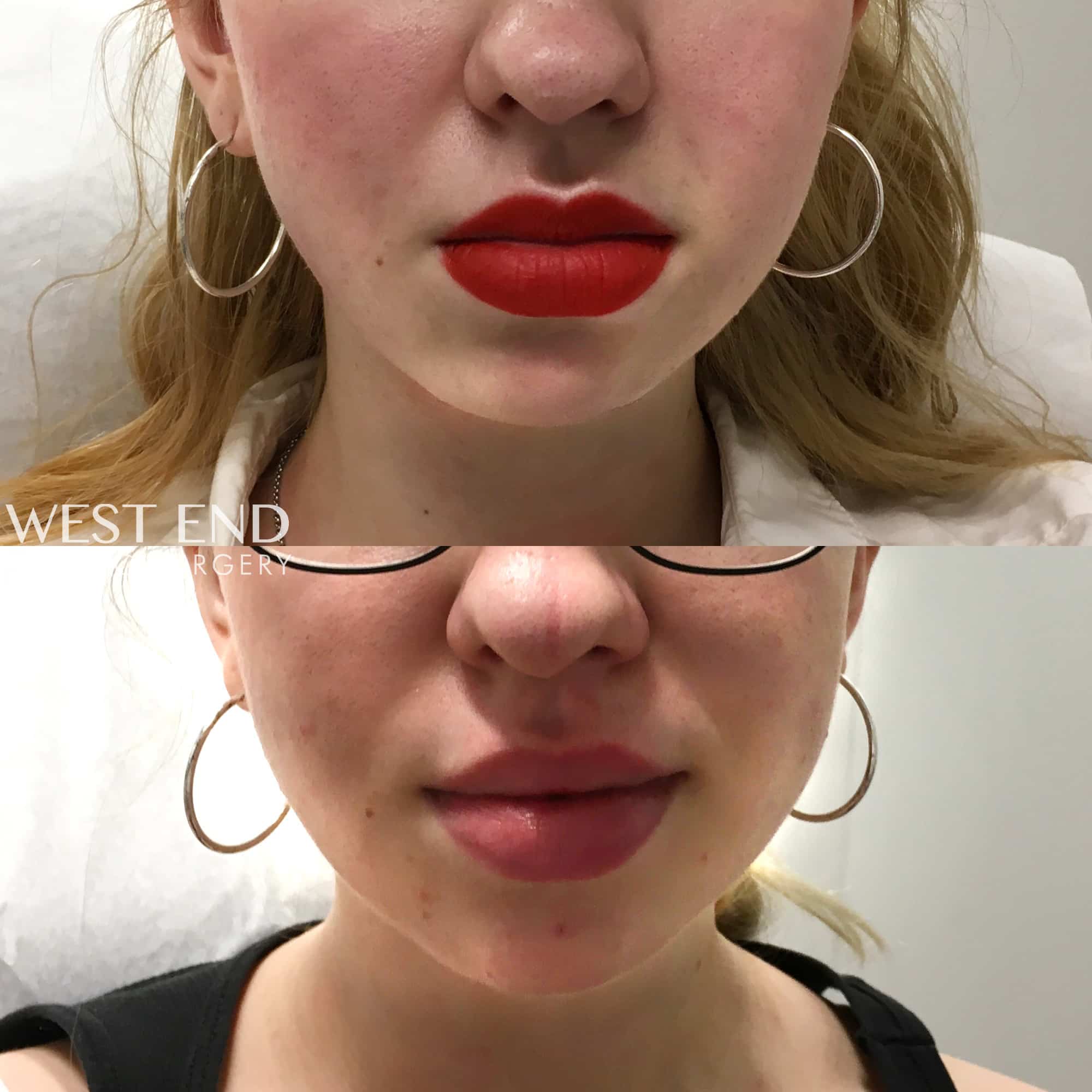 Kybella & Chin Augmentation with Dermal Filler