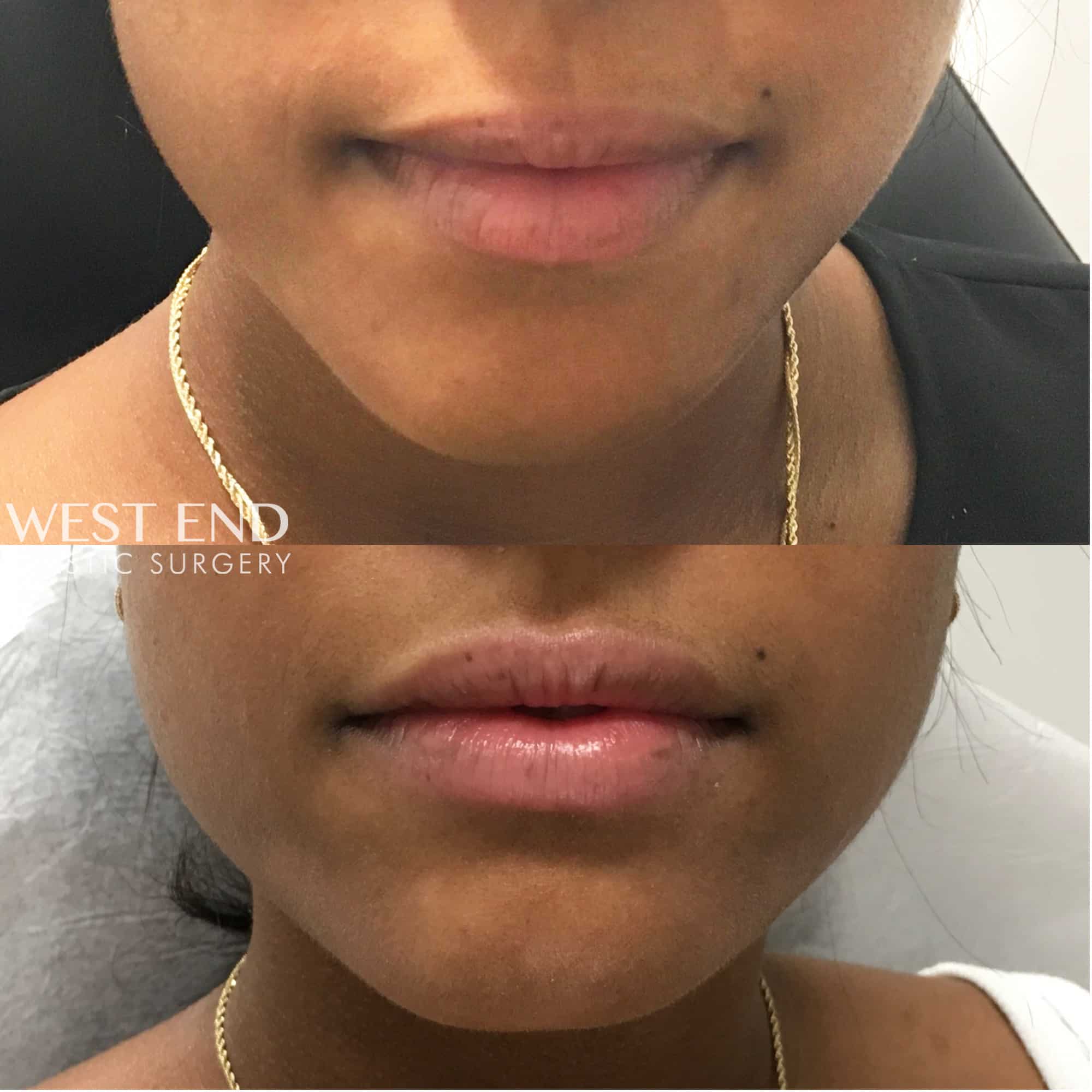 Lip Filler