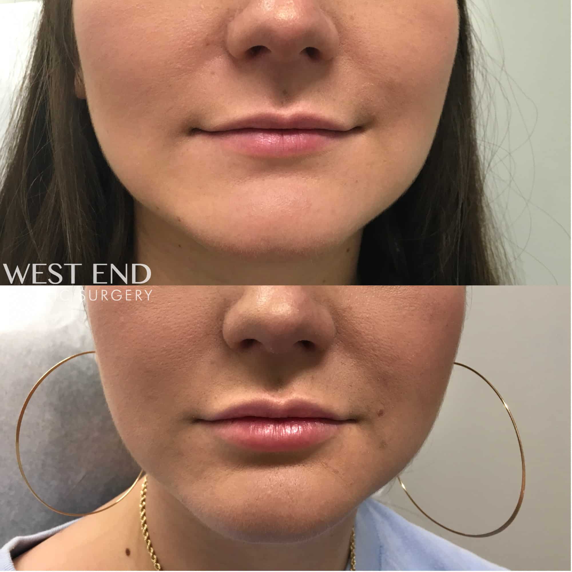Lip Filler