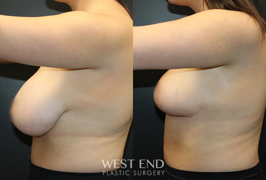 Breast Reduction