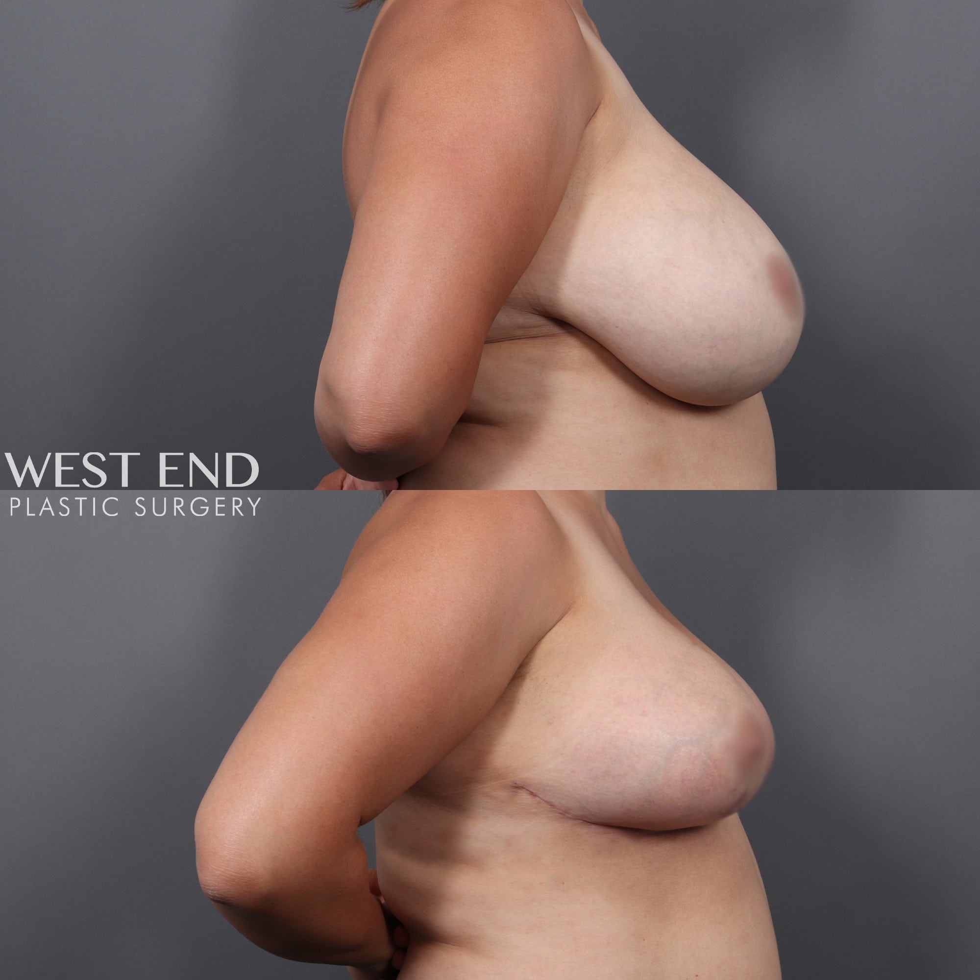 Breast Reduction