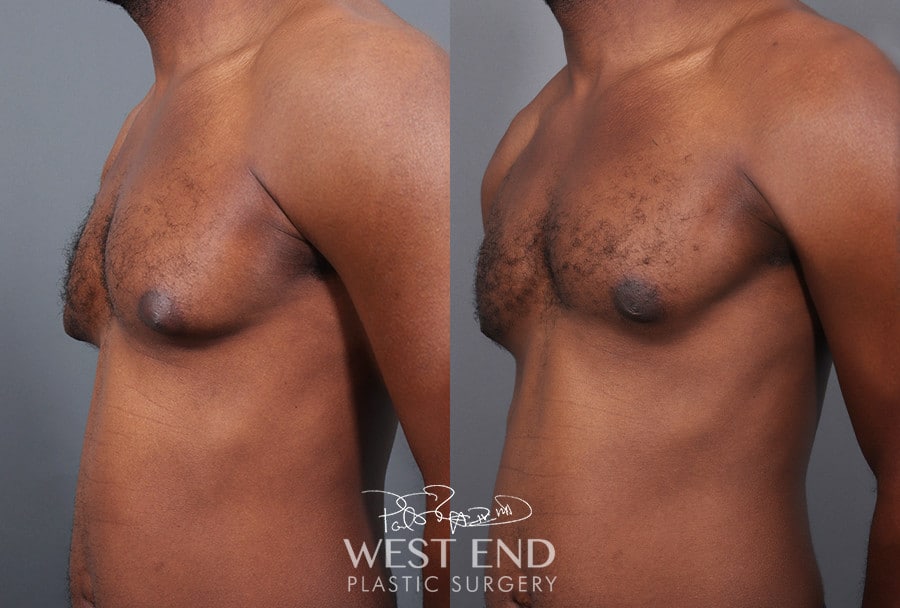 Gynecomastia (using Liposuction & Renuvion)