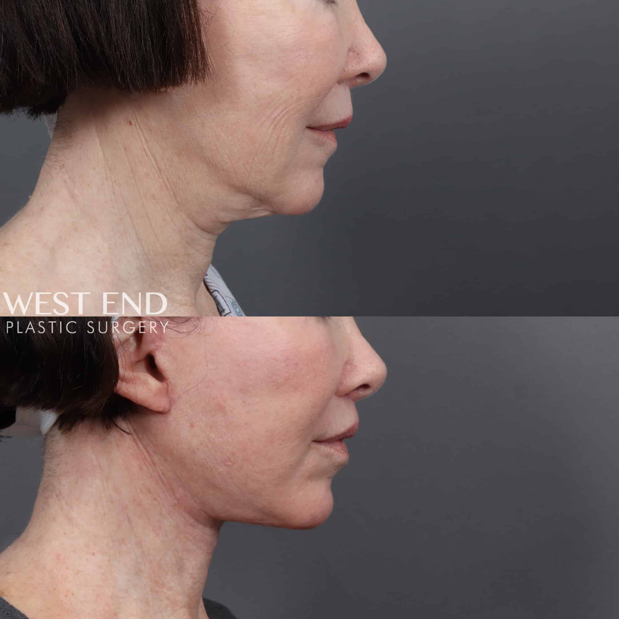 Facelift, Neck Lift & Upper Lip Lift