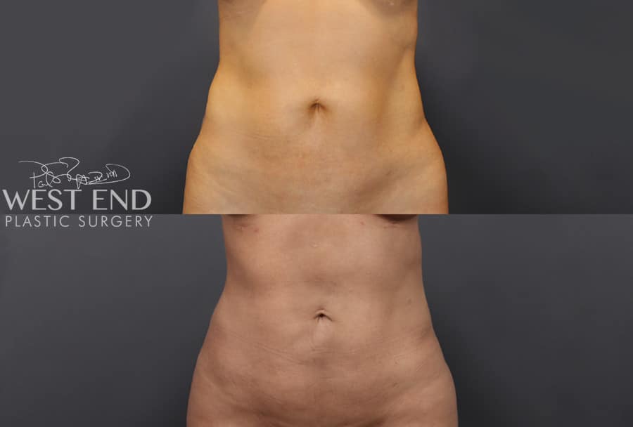 Liposuction and Renuvion Skin Tightening