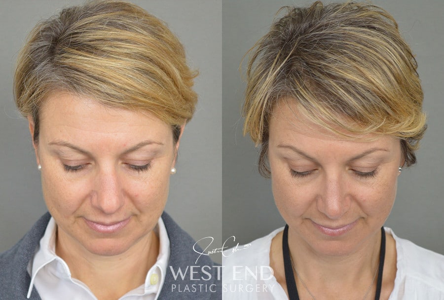 Rhinoplasty before photo. Individual results may vary.
